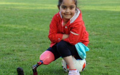 Το  αθλητικό προσθετικό πόδι της μικρής Anu