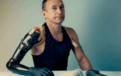 Όταν ο ειδικός των τεχνητών άκρων γίνεται ασθενής: Η ιστορία Τζιμ Άσγουορθ-Μπομόν